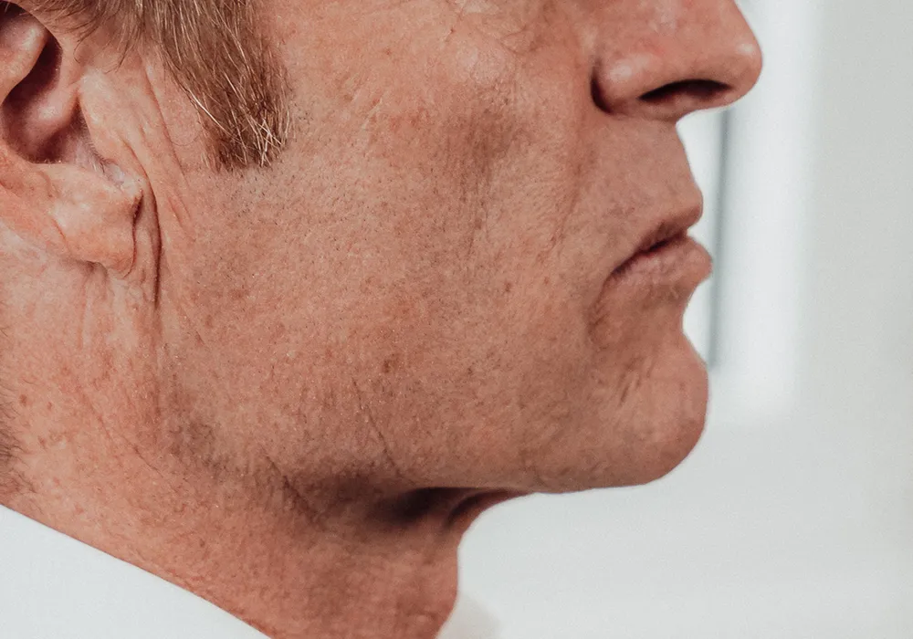 Individueller Unterkiefervorschub