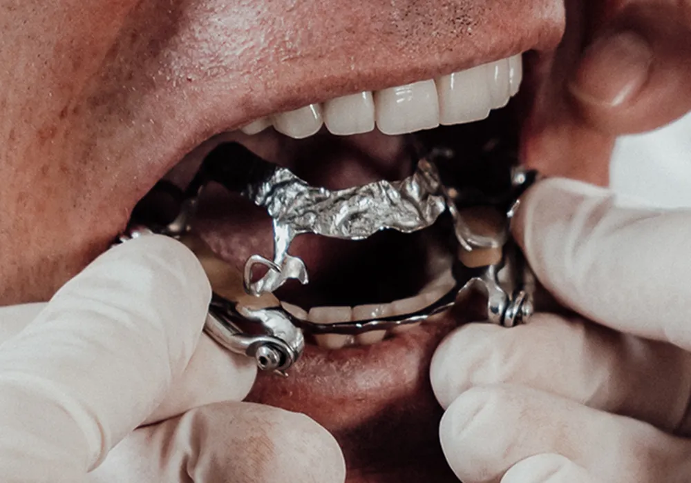 Einsetzen der Protrusionsschiene